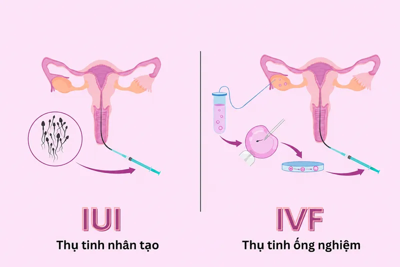 IUI và IVF là hai phương pháp hỗ trợ sinh sản khác nhau về nơi thụ tinh, mức độ can thiệp, chi phí và đối tượng phù hợp.