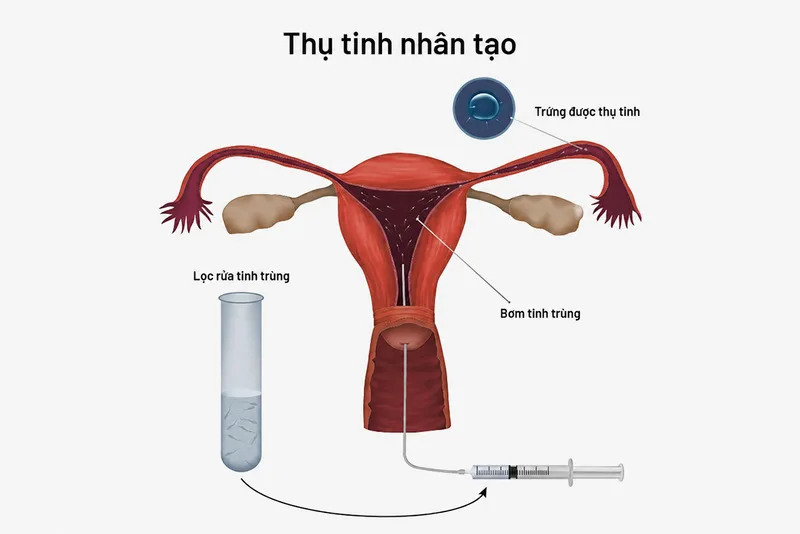 Thụ tinh nhân tạo thường được hiểu là kỹ thuật IUI, giúp đưa tinh trùng đã xử lý vào buồng tử cung để tăng cơ hội thụ thai.